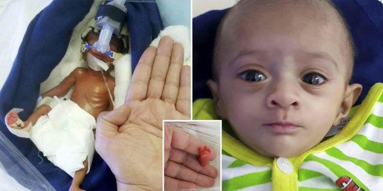 Beratnya Setara Coklat Besar, Bayi Prematur Terkecil di India Berjuang untuk Hidup