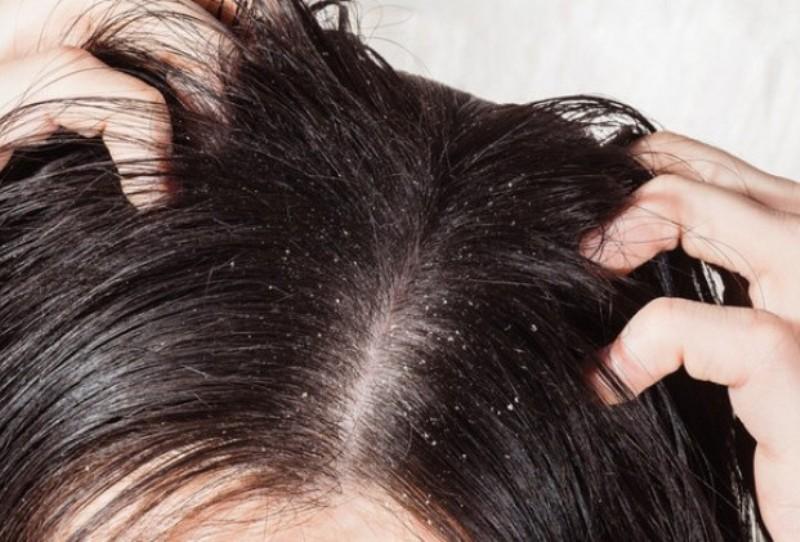 Cara Tepat Mengatasi Ketombe
