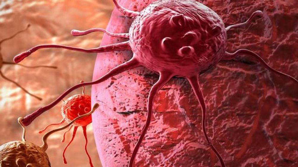Kenali, Ini Perbedaan Kista dan Tumor